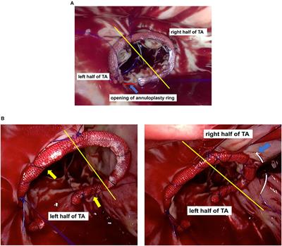 Minimally Invasive Isolated Tricuspid Valve Repair After Left-Sided Valve Surgery: A Single-Center Experience